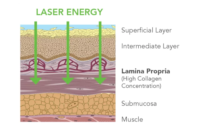 Cross-section diagram of the soft palate lining showing laser energy passing through the surface layers to the collagen-rich lamina propria