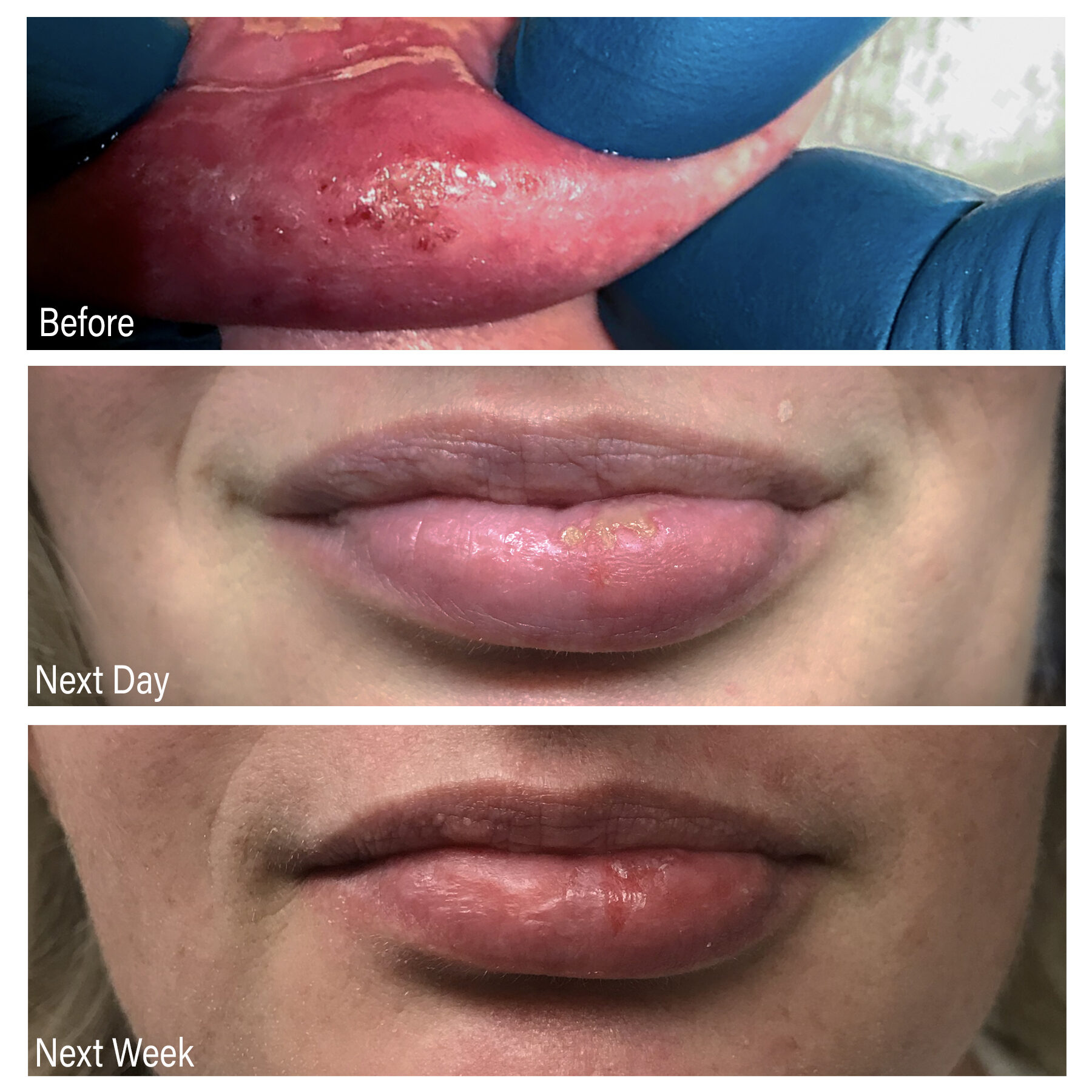Cold sore removal with a CO2 laser in Utah