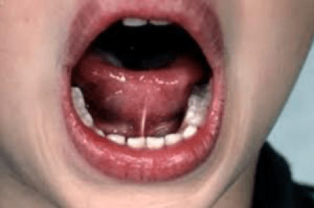 Tongue Tie Evaluation Close-up of an infant's mouth during a tongue-tie assessment