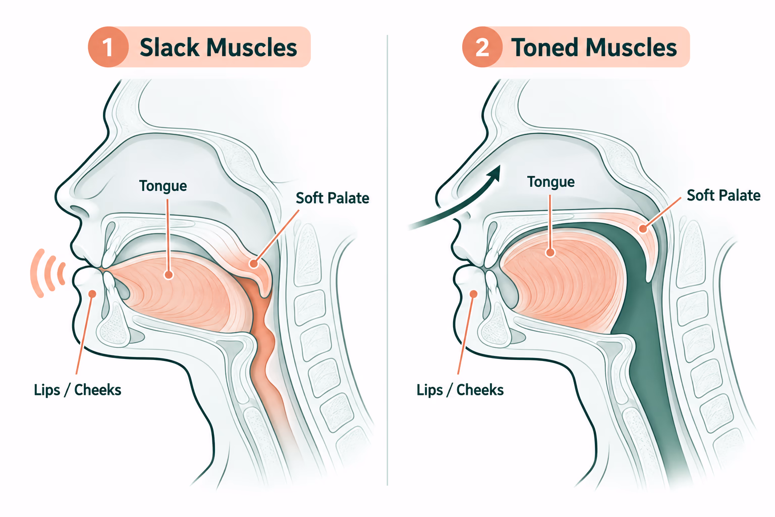 Side cross-section comparing slack throat muscles that let the airway narrow with toned muscles that keep it open