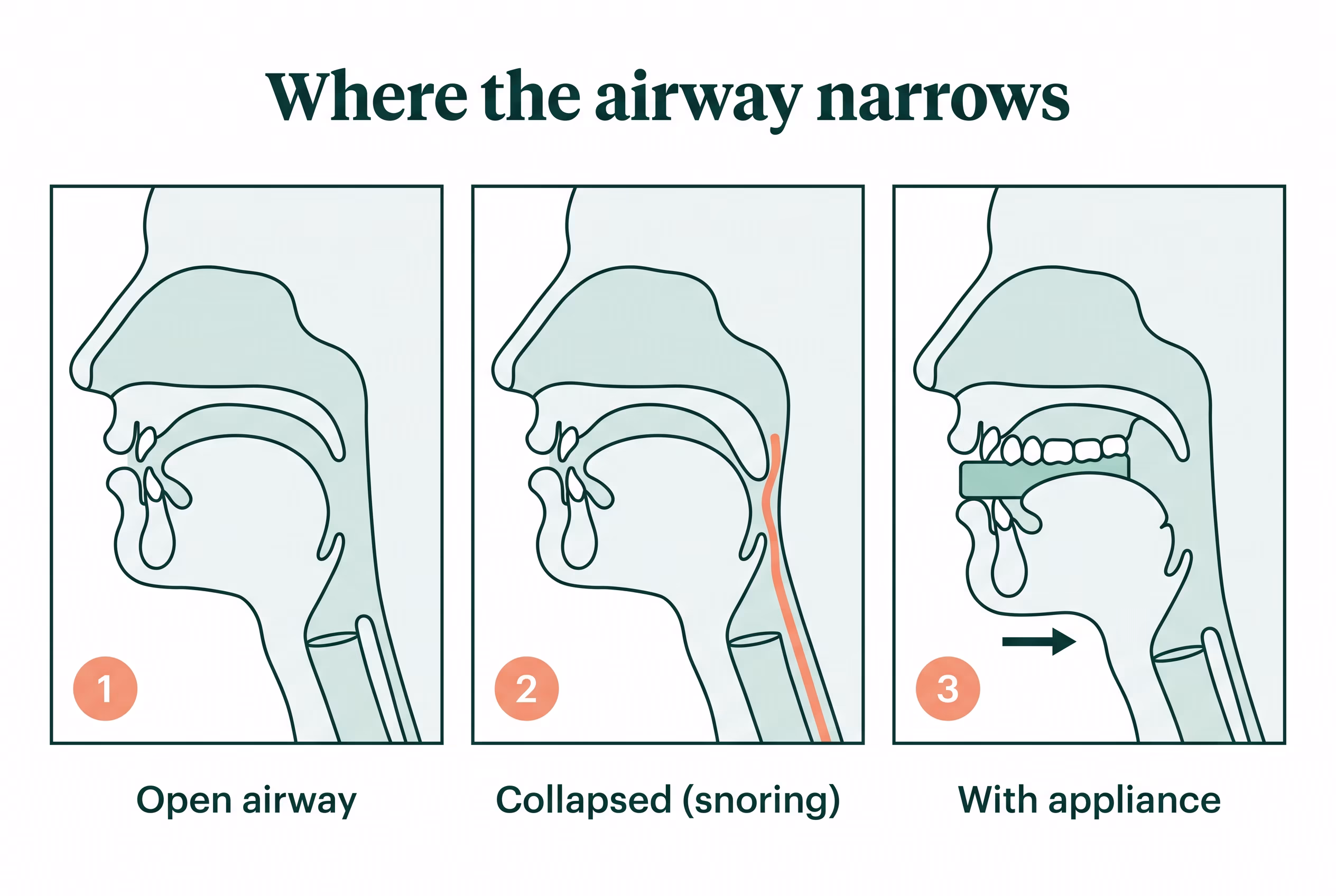 Diagram of an open airway, a narrowed airway causing snoring, and the airway held open by an oral appliance