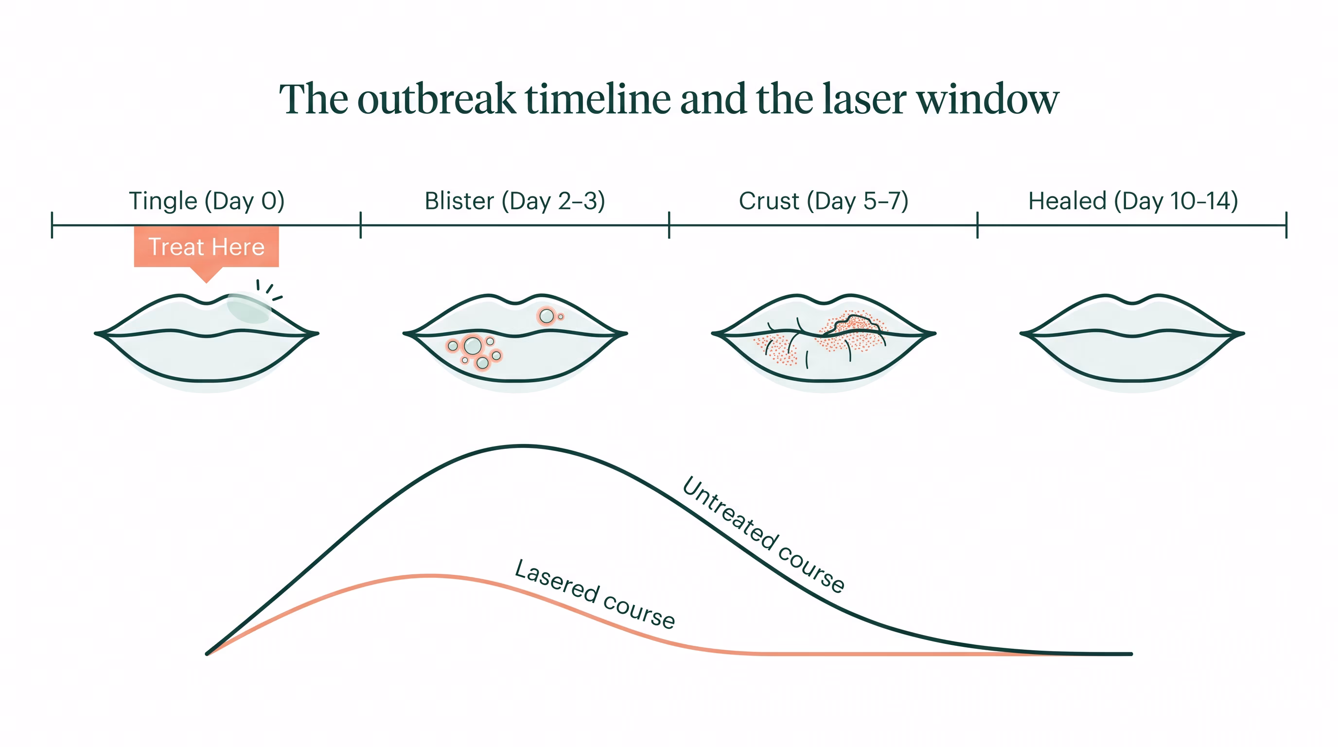 Timeline of a cold sore outbreak from tingle through healing, with the laser treatment window marked at the tingle stage