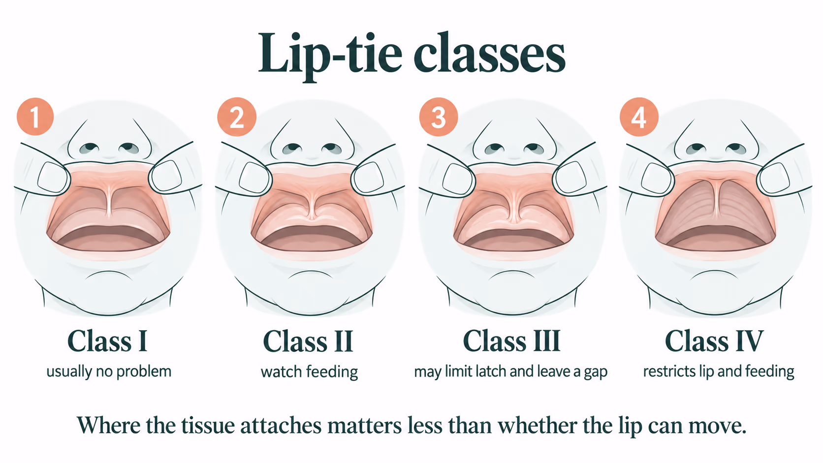 Four illustrations of an upper lip lifted, showing the labial frenulum attaching progressively lower