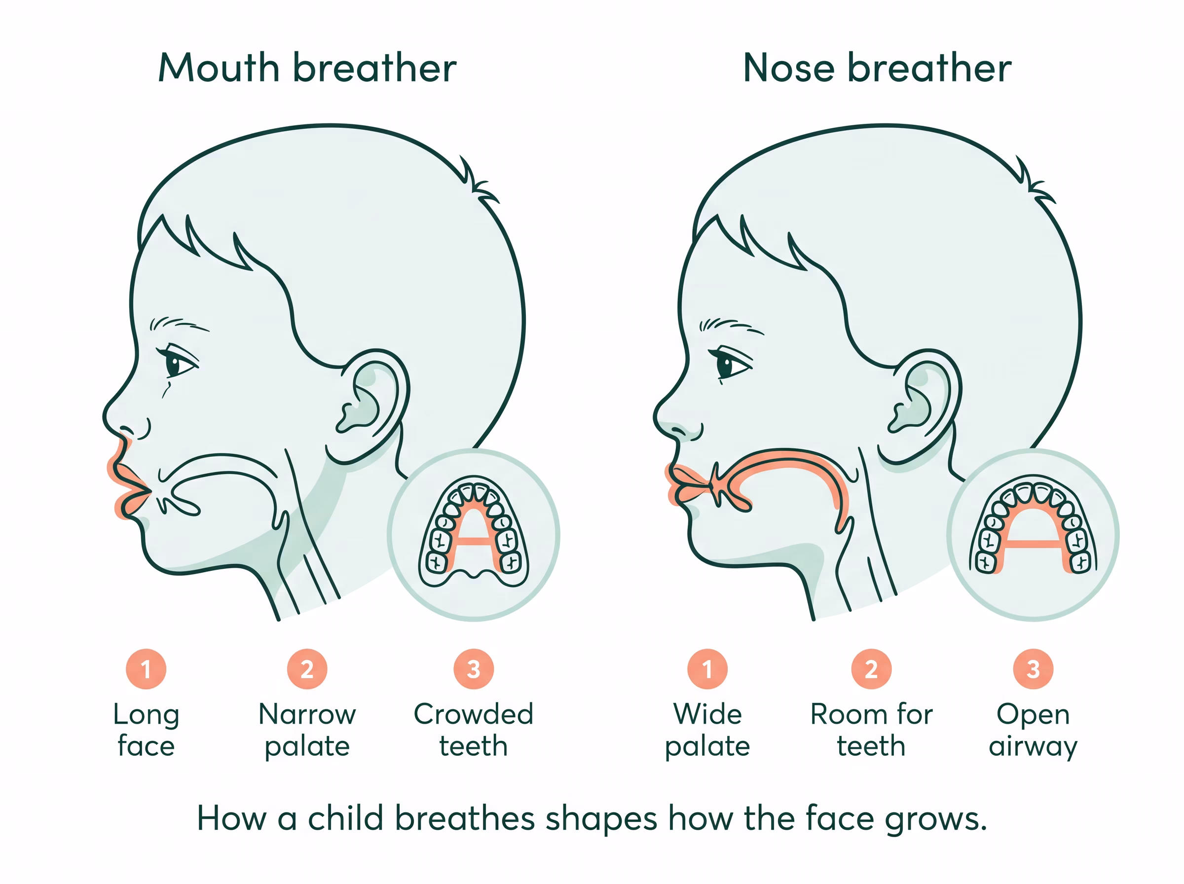 Two child profiles compared side by side: a mouth breather with a long face and narrow palate, and a nose breather with a broad palate and open airway