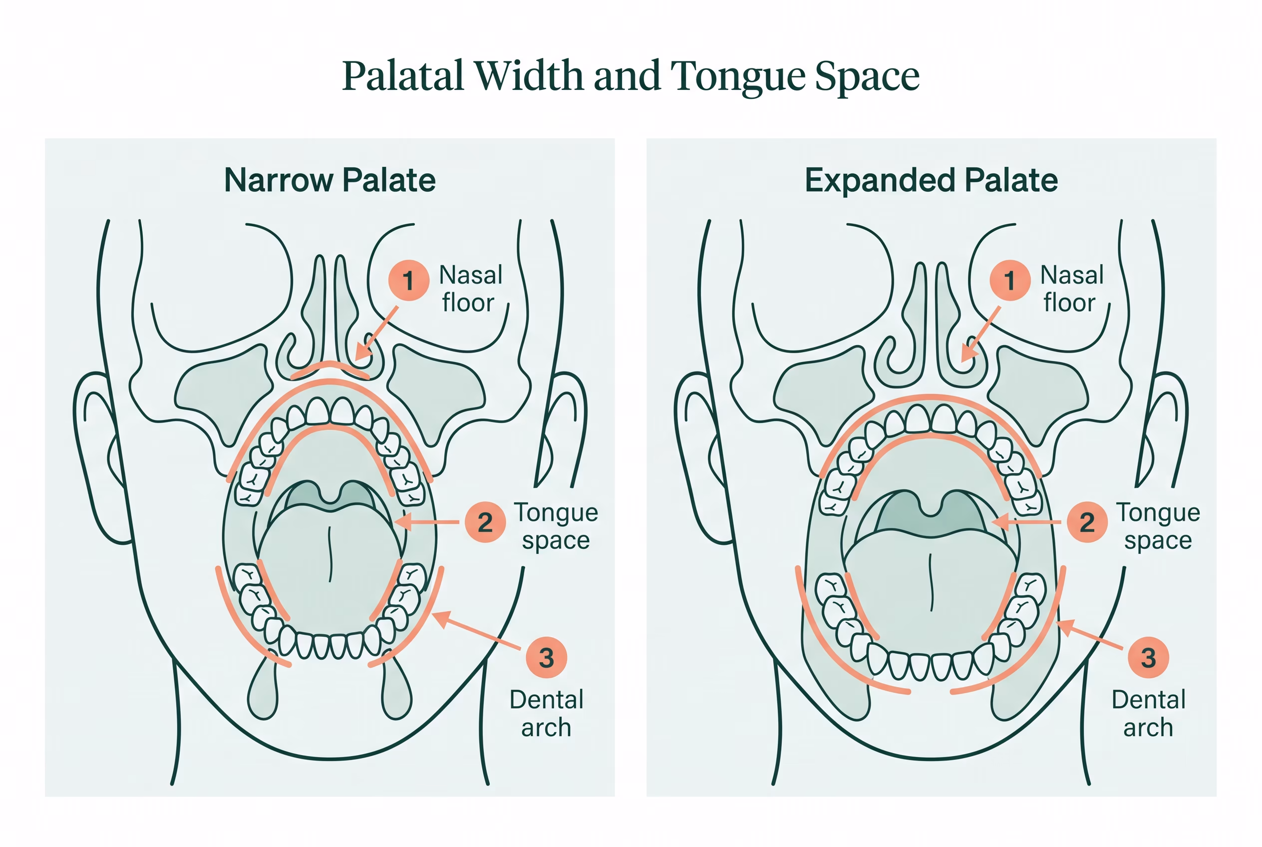 Frontal cross-section comparing a narrow palate crowding the tongue and nasal airway with an expanded palate that gives both more room