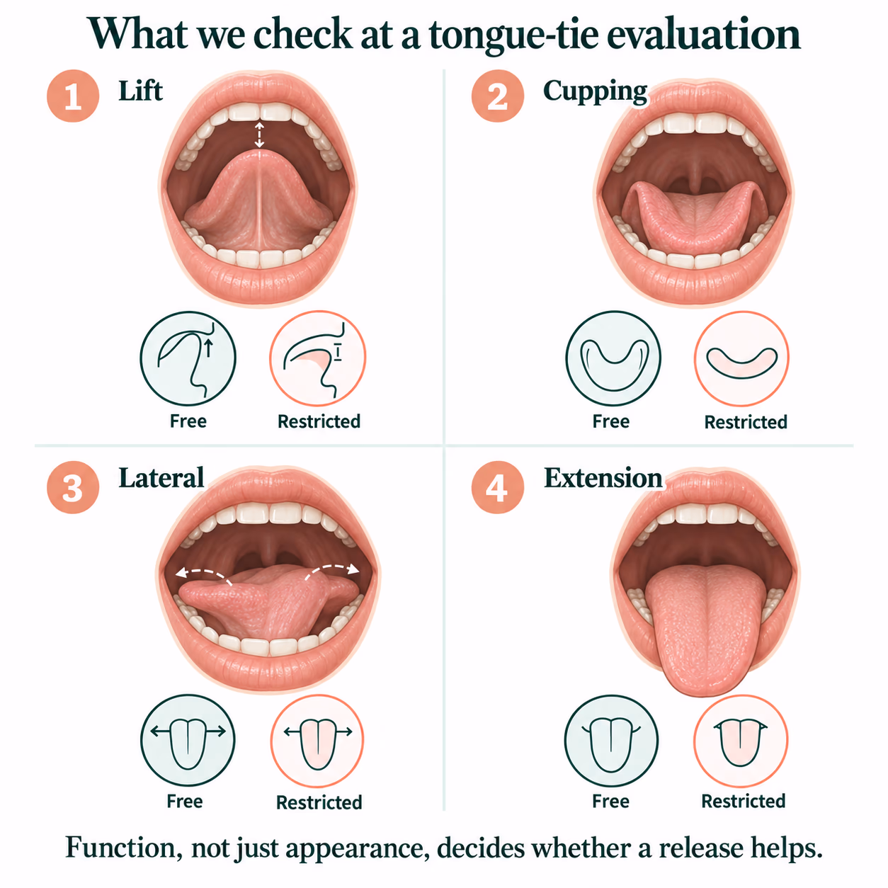 Four illustrations of tongue lift, cupping, lateral movement and extension used to check tongue-tie function
